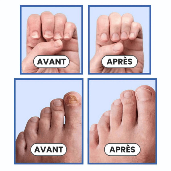 OrthoCose™ | Appareil anti-mycoses